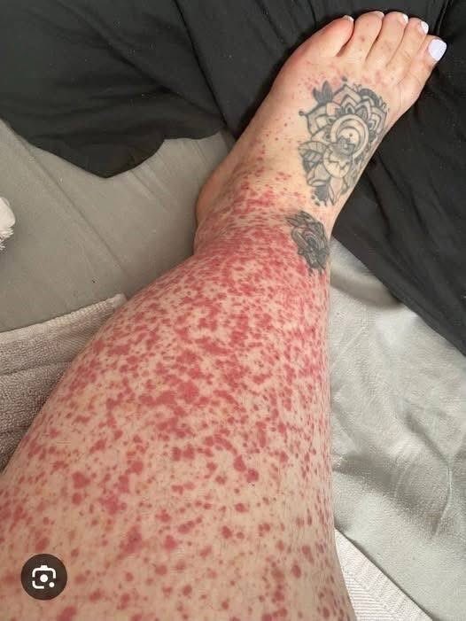 What is the diagnosis based on the image?

#MEDHM #MedX <a href="/IhabFathiSulima/">Dr Ihab Suliman</a>