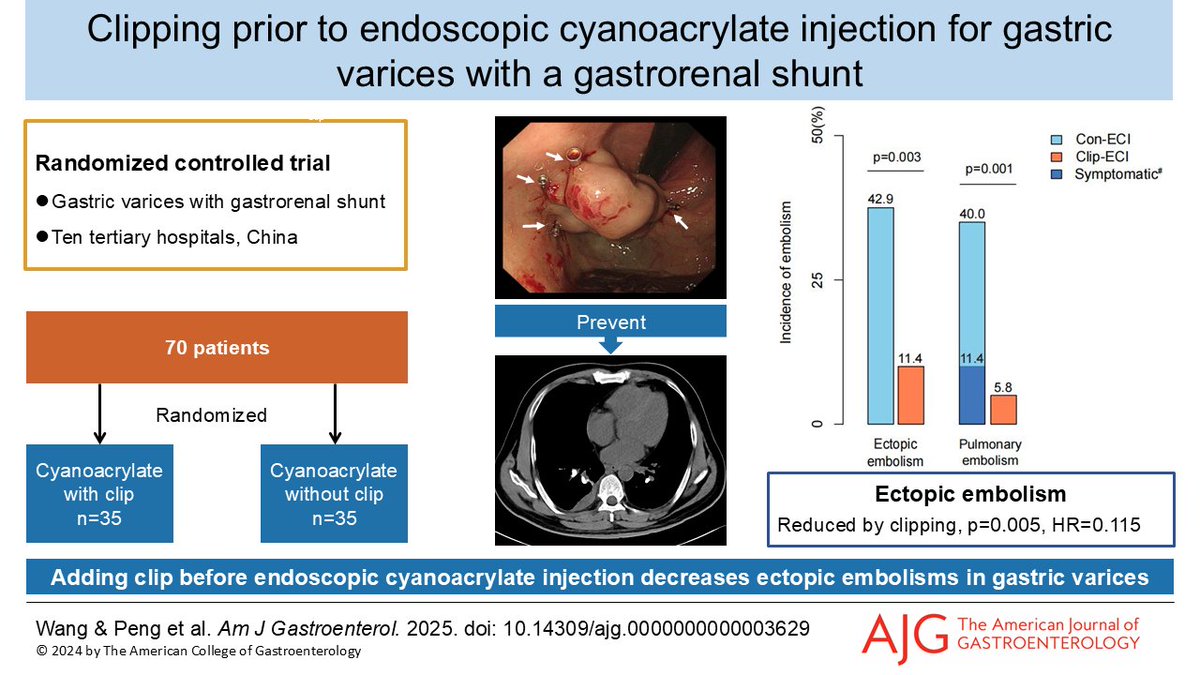 AJG - The American Journal of Gastroenterology (@amjgastro) on Twitter photo Adding Clip Before Endoscopic Cyanoacrylate Injection Decreases Ectopic Embolisms in Gastric Varices: A Randomized Controlled Trial
Wang & Peng, et al.
📕 doi.org/10.14309/ajg.0…
<a href="/MLongMD/">Millie Long</a> <a href="/JasmohanBajaj/">Jasmohan Bajaj</a> Adding Clip Before Endoscopic Cyanoacrylate Injection Decreases Ectopic Embolisms in Gastric Varices: A Randomized Controlled Trial
Wang & Peng, et al.
📕 doi.org/10.14309/ajg.0…
<a href="/MLongMD/">Millie Long</a> <a href="/JasmohanBajaj/">Jasmohan Bajaj</a>