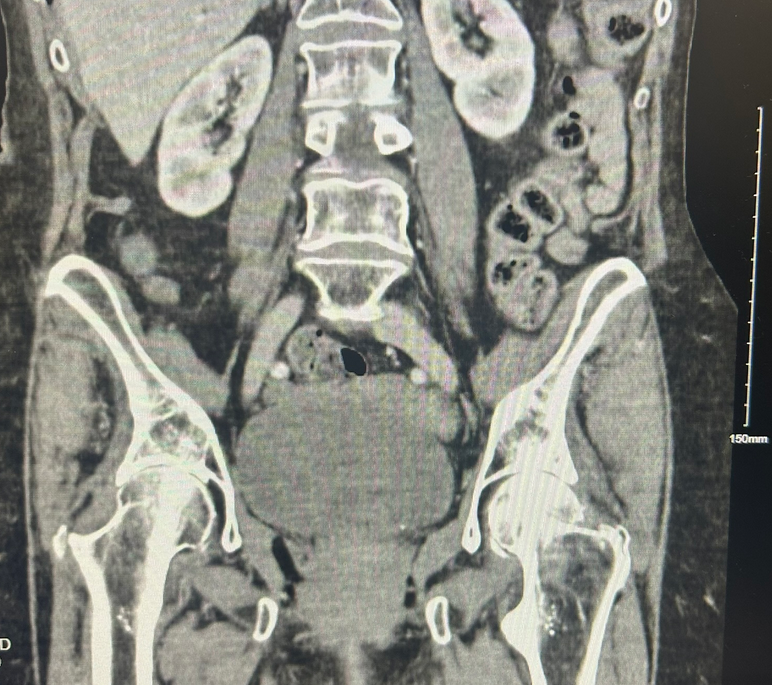 EM Case Challenge of the week: Groin/LLQ pain
erpocketbooks.com/ct4/