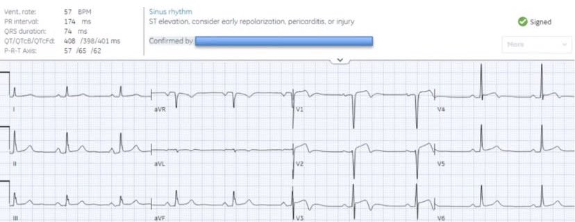 heartsECGcourse's tweet photo. 60 year old with exertional chest pain, now improving. Is this early repol, pericarditis or injury?
#ECG #EKG #ECGinterpretation #medstudent #medstudentTwitter #resident #nurse #paramedic #cardiactech #emergencyMedicine #cardioTwitter #foamed #meded #medTwitter #CardioEd https://t.co/DUaepa5fpU