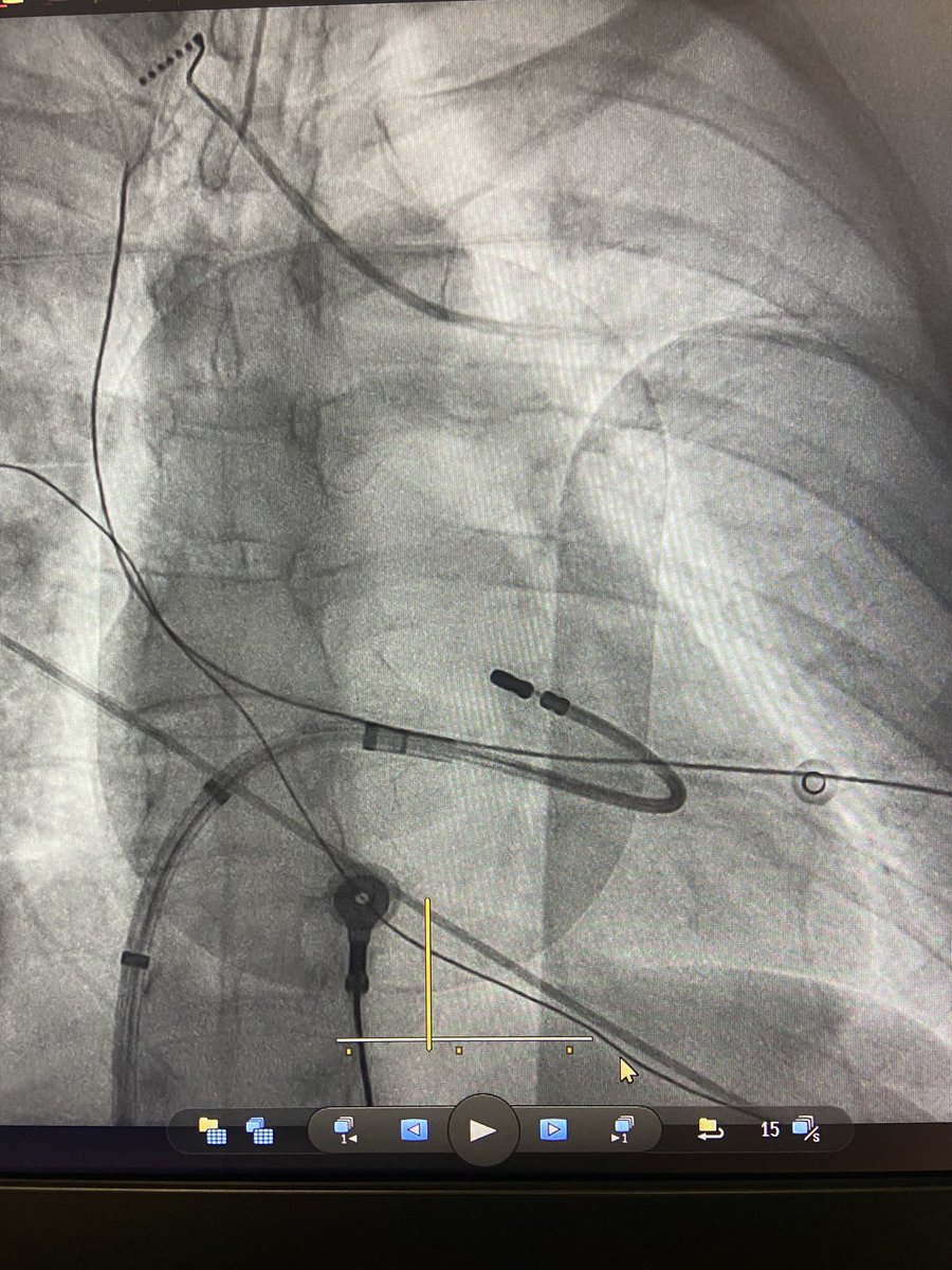 José Alderete M (@jalderetem) on Twitter photo #Epeeps 🫀
Left anterior fascicle PVC ablation at <a href="/Clinica_Teknon/">Centro Médico Teknon</a> with <a href="/DrBerruezo/">DrAntonioBerruezo</a>
#ablatePVC #Epeeps 🫀
Left anterior fascicle PVC ablation at <a href="/Clinica_Teknon/">Centro Médico Teknon</a> with <a href="/DrBerruezo/">DrAntonioBerruezo</a>
#ablatePVC