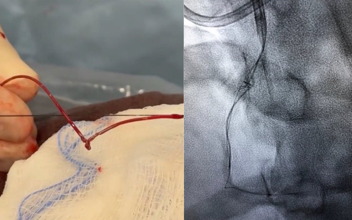 Lorenzo Azzalini (@lazzalinimd) on Twitter photo #IVUS catheter suicide is a thing. Do NOT activate the imaging function on a rotational IVUS system BEFORE crossing the lesion, as it can twist & form a knot. Be careful out there. onlinelibrary.wiley.com/doi/10.1002/cc…
Nice work by <a href="/RezMasoomi/">Reza Masoomi</a> & Juan del Cid.
<a href="/KateKearney4/">Kate Kearney</a> <a href="/DrBillLombardi/">Dr. Bill Lombardi</a> #IVUS catheter suicide is a thing. Do NOT activate the imaging function on a rotational IVUS system BEFORE crossing the lesion, as it can twist & form a knot. Be careful out there. onlinelibrary.wiley.com/doi/10.1002/cc…
Nice work by <a href="/RezMasoomi/">Reza Masoomi</a> & Juan del Cid.
<a href="/KateKearney4/">Kate Kearney</a> <a href="/DrBillLombardi/">Dr. Bill Lombardi</a>