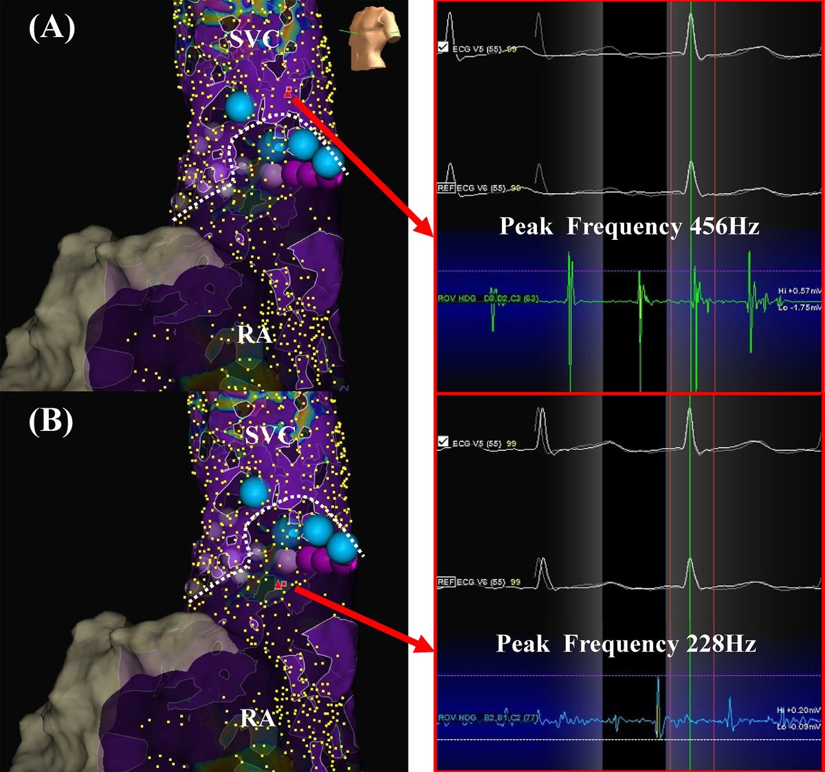 Heart Rhythm Case Reports tweet media
