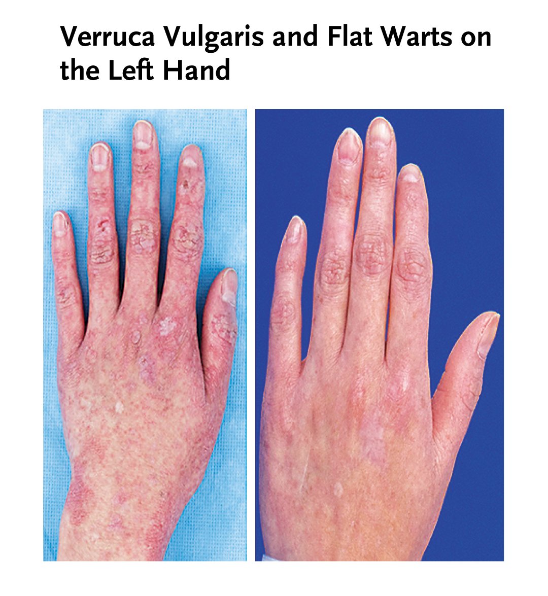 In a patient with pathogenic ZAP70 mutations and HPV19-integrated SCC, restoring T-cell receptor signaling by stem-cell transplantation resolved HPV-related disease, revealing a direct oncogenic role for β-HPV in immunodeficiency. Read the Brief Report: nej.md/4lTiTCC