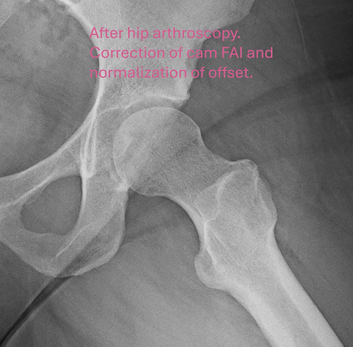 Dr. Derek Ochiai (@drderekochiai) on Twitter photo Cam-type #HipFAI doesn't need to have a big "bump" to be symptomatic. In this case,  image on the left shows a lack of offset . Image on the right shows an anatomic correction after #HipArthroscopy. This normalizes the pressure on the labrum, allowing it to heal with repair. Cam-type #HipFAI doesn't need to have a big "bump" to be symptomatic. In this case,  image on the left shows a lack of offset . Image on the right shows an anatomic correction after #HipArthroscopy. This normalizes the pressure on the labrum, allowing it to heal with repair.