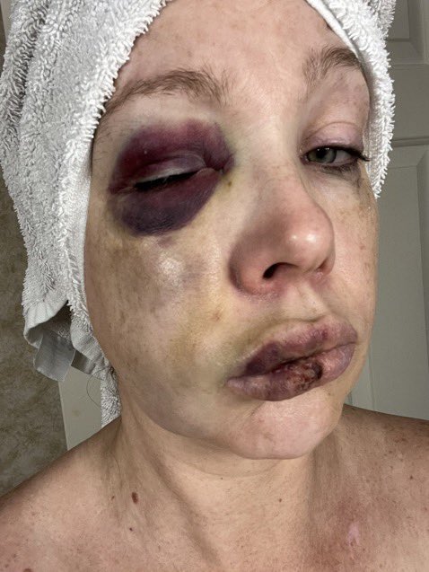 BREAKING - This is Hamilton County Prosecutor Connie Pillich, who allowed one of the black suspects involved in the beating of White people at a Cincinnati jazz fest to be released on $400 bail, and this is one of the White victims, Holly, who was beaten.