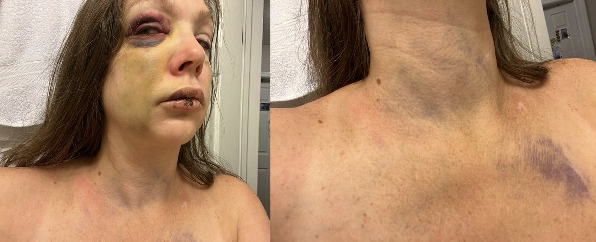 This is the aftermath of the woman knocked out and beaten in the street during the weekend's Jazz Festival in Cincinnati.

Plan accordingly...

#CityLife #Cincinnatiattack #CincinnatiBrawl #crime #injuries #urban #democrats #ohio