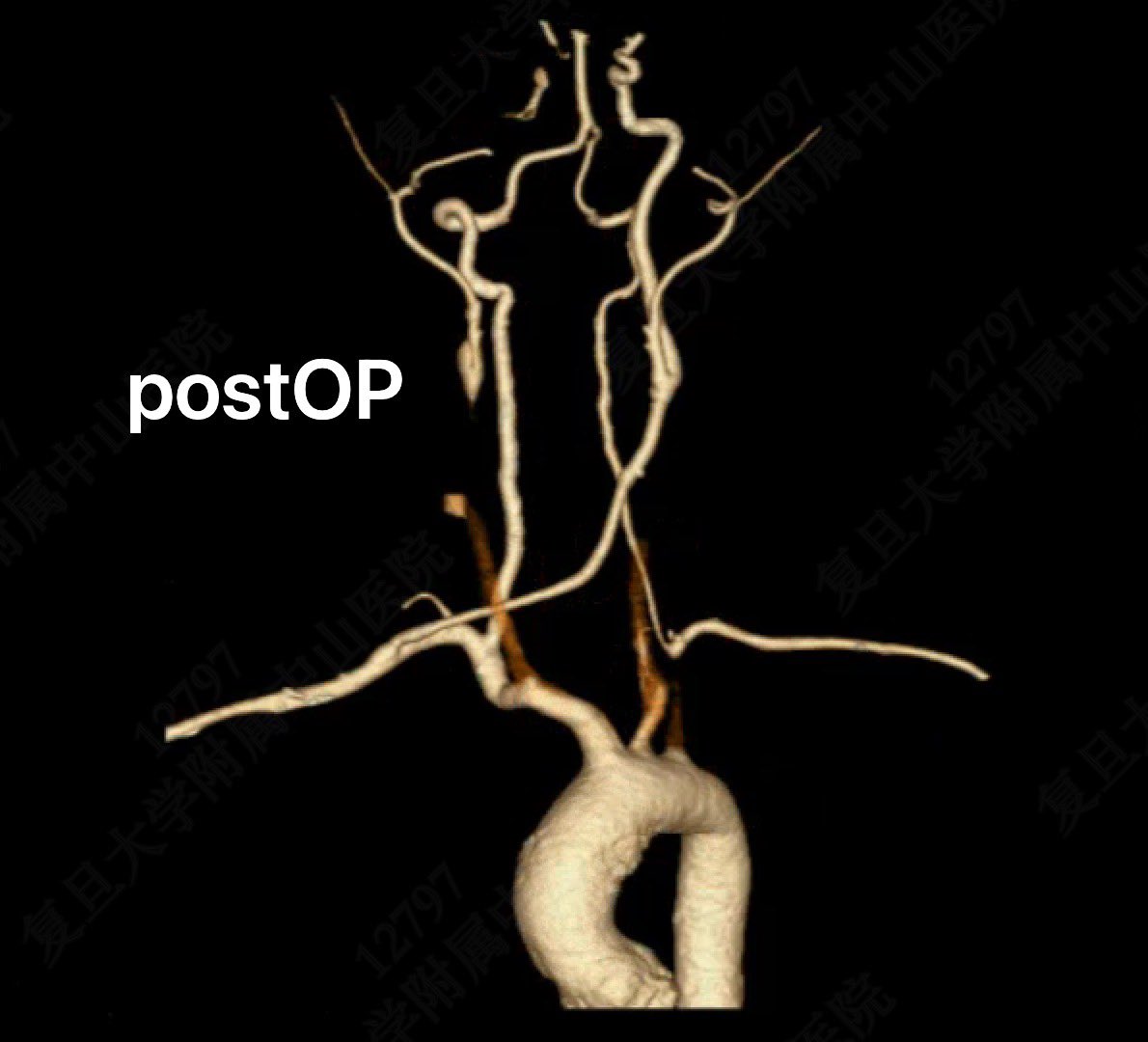 yuejianing's tweet photo. Right Subclavian to left Carotid Artery Retropharyngeal Bypass with GSV. This is a Takayasu case. The video shows the route behind the esophagus, which has a low risk of infection, allows for possible postoperative tracheostomy, and using the GSV does not cause a noticeable foreign body sensation when swallowing.