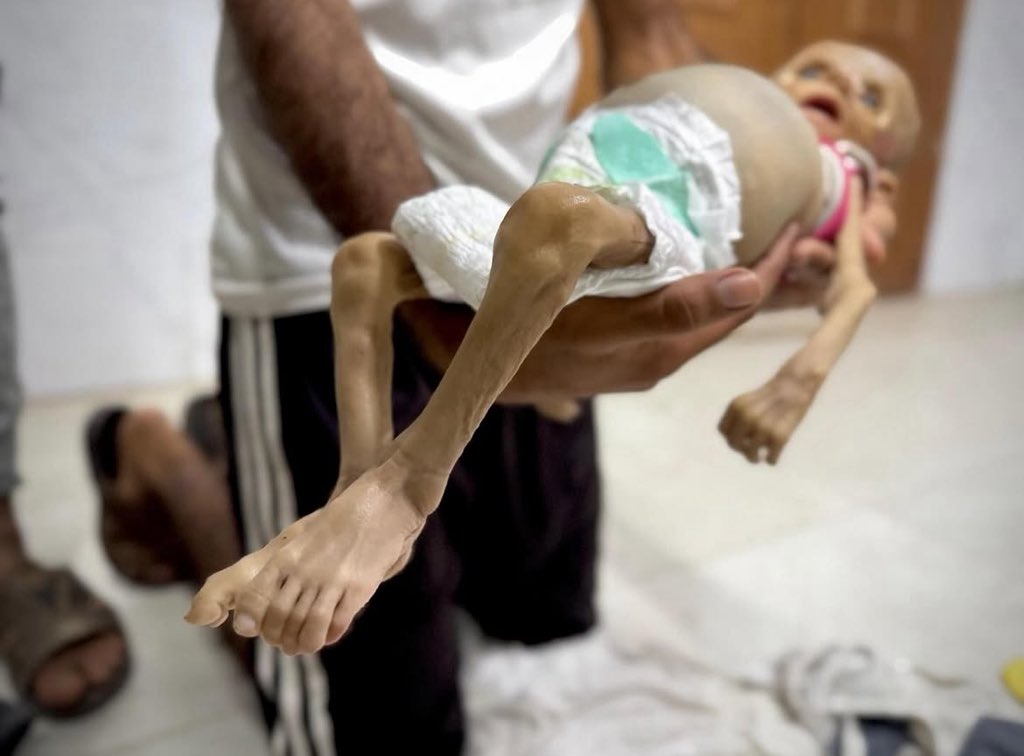 Infant Zeinab Abu Halib martyrdom due to hunger

Zainab Abu Halib, 6 months old, was martyred in Nasser Medical Complex south of the Gaza Strip, due to hunger and severe malnutrition