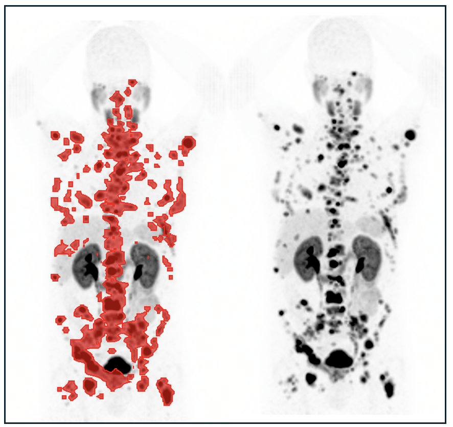 Louise Emmett (@drlouiseemmett) on Twitter photo PSMA-PET total tumour volume is prognostic for overall survival in mCRPC.
thelancet.com/journals/lanon…
PSMA-PET value extends beyond selection for PSMA-RLT therapy in metastatic prostate cancer.
urotoday.com/video-lectures…
<a href="/ANZUPtrials/">ANZUP</a> @trialscentre <a href="/PCFnews/">Prostate Cancer Foundation</a> <a href="/MovemberAUS/">Movember Australia</a> PSMA-PET total tumour volume is prognostic for overall survival in mCRPC.
thelancet.com/journals/lanon…
PSMA-PET value extends beyond selection for PSMA-RLT therapy in metastatic prostate cancer.
urotoday.com/video-lectures…
<a href="/ANZUPtrials/">ANZUP</a> @trialscentre <a href="/PCFnews/">Prostate Cancer Foundation</a> <a href="/MovemberAUS/">Movember Australia</a>