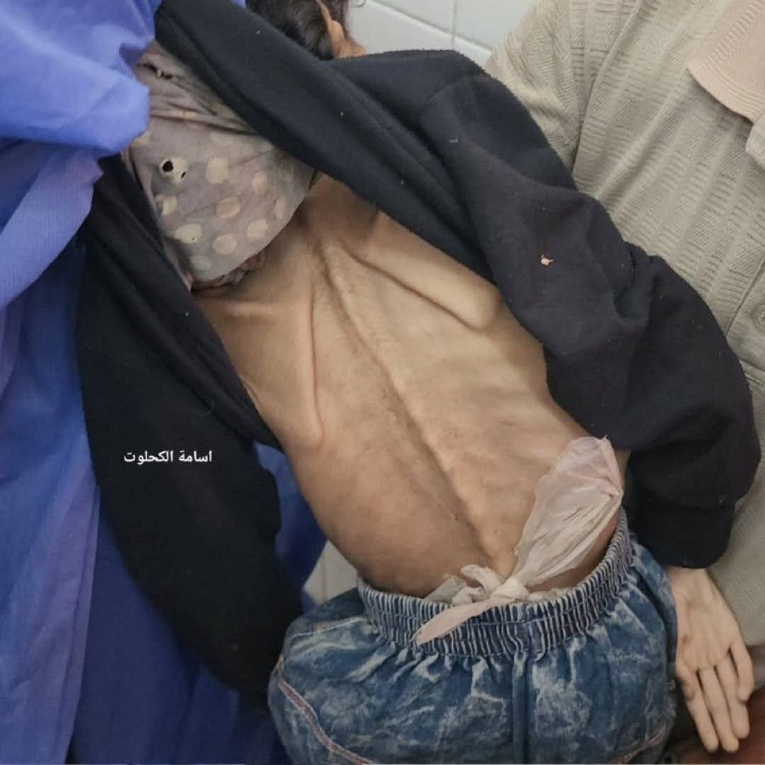 Her name was Noor. 

She was 10 years old. 

She died from severe malnutrition. 

lsraeI starved her to death.