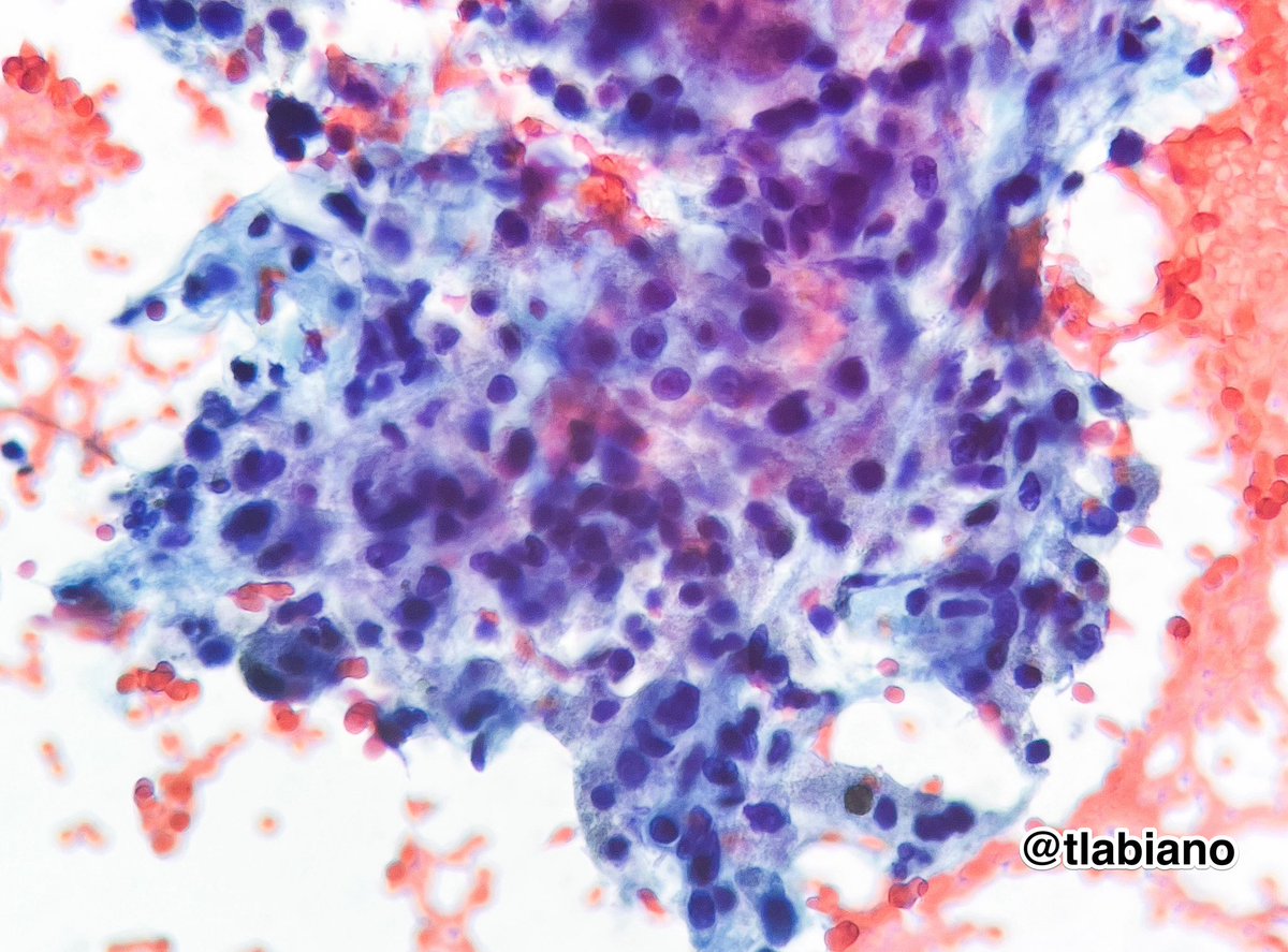 Tania Labiano (@tlabiano) on Twitter photo 💉🫁Transthoracic #FNA #cytology of pleuropulmonary mass(w/ a magnificent cell block!
🔬Cell clusters w/ nuclear pleomorfism and abundant pale,fragile cytoplasm.
🏷️PAX8, CD10➕. TTF1 neg
Dx: RCC hematogenous spread mtt.
#cytopath #pulmpath #cytohistocorrelation <a href="/IACytology/">International Academy Cytology</a> 💉🫁Transthoracic #FNA #cytology of pleuropulmonary mass(w/ a magnificent cell block!
🔬Cell clusters w/ nuclear pleomorfism and abundant pale,fragile cytoplasm.
🏷️PAX8, CD10➕. TTF1 neg
Dx: RCC hematogenous spread mtt.
#cytopath #pulmpath #cytohistocorrelation <a href="/IACytology/">International Academy Cytology</a>