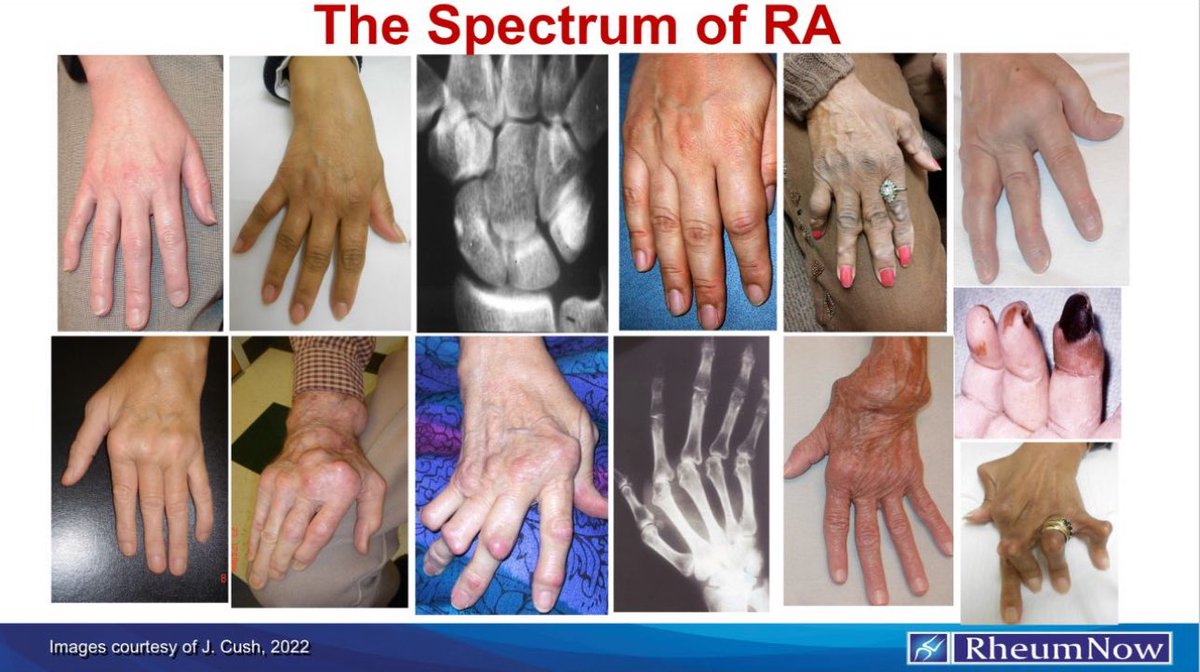 By <a href="/RheumNow/">Dr. John Cush</a> 

#RheumatoidArthritis #RA #synovitis #InflammatoryArthritis