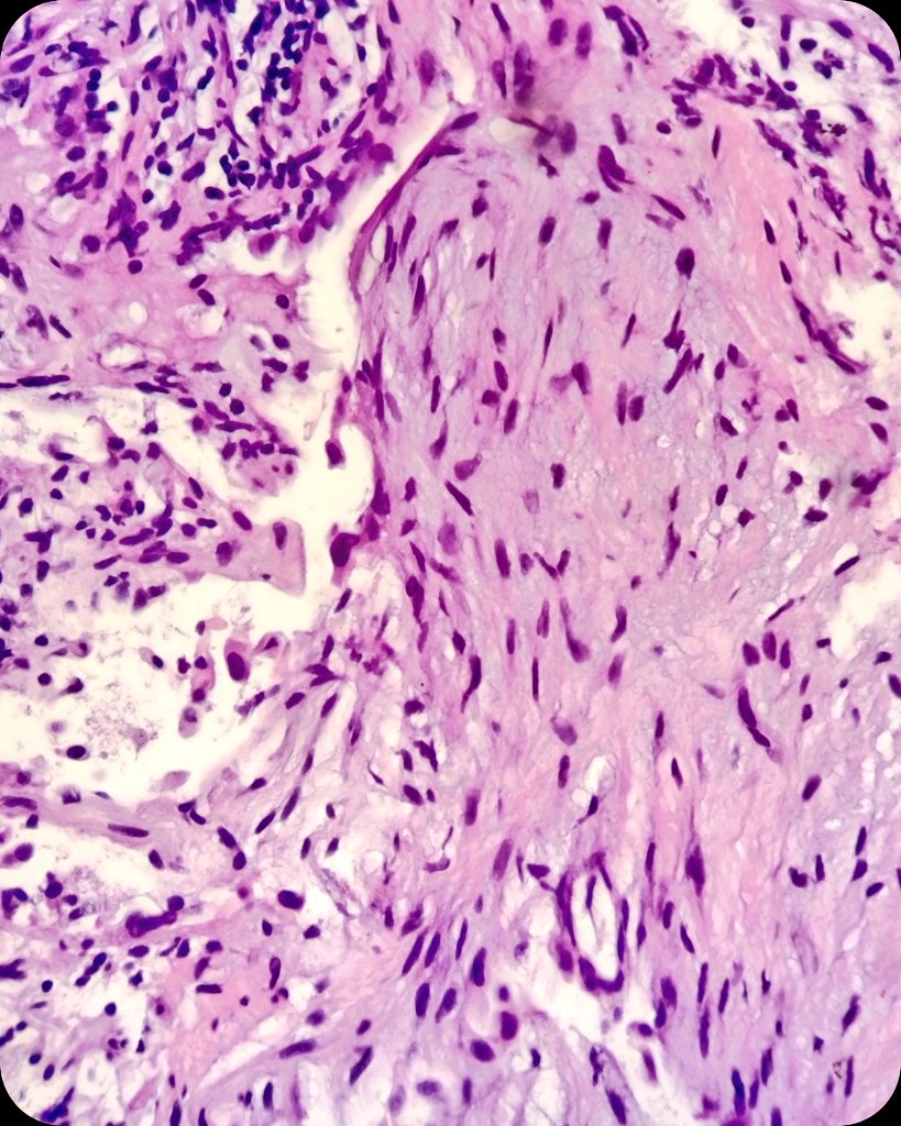 🫁 Interstitial lung pattern. Suspicious for UIP.
❄️ Transbronchial CryoBiopsy.
🔬 Fibroblastic foci.

#LungPath #PulmPath #PathX