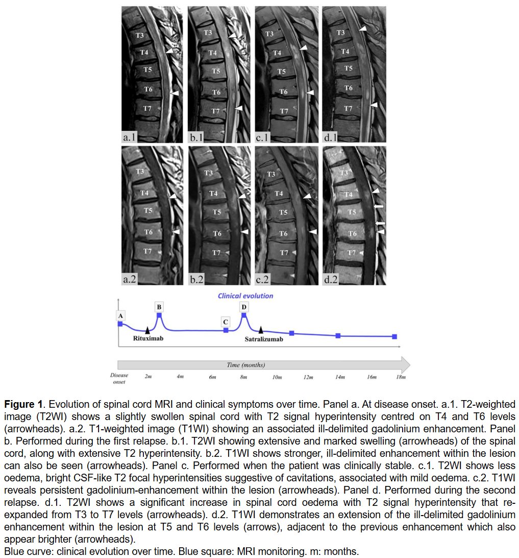 Gadolinium enhancement lasted 14 months in a patient with aquaporin-4-positive myelitis #NMOSD, suggesting long-lasting enhancement could be crucial for diagnostic accuracy.

Case report from <a href="/APHP/">Assistance Publique – Hôpitaux de Paris (AP-HP)</a> <a href="/HopPitieSalpe/">Hôpital Pitié-Salpêtrière AP-HP</a> ▶️ journals.sagepub.com/doi/abs/10.117…

1/🧵