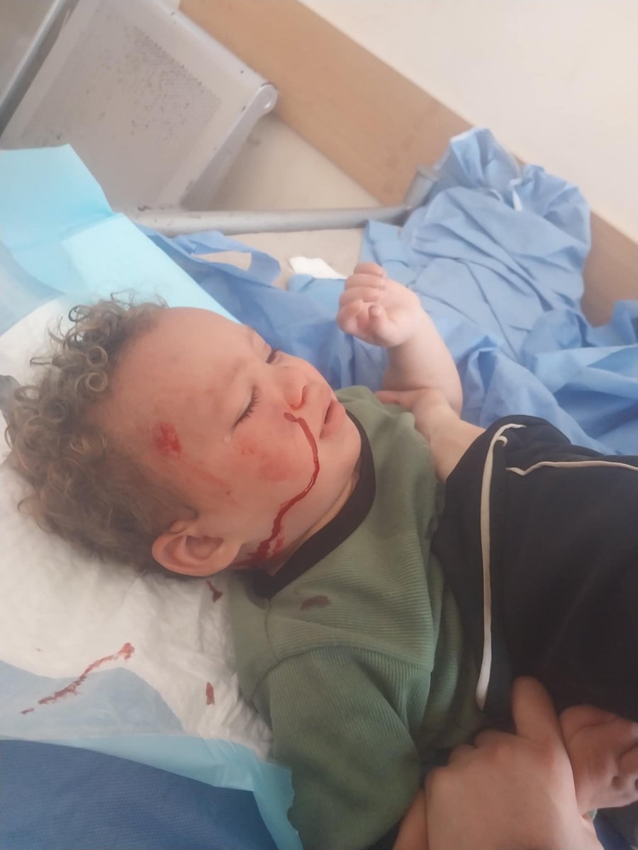 Anhedonya (@psanhedonya) on Twitter photo 🆘 <a href="/ayt_abd97575/">Latifa from Gaza</a> sons abscess was drained w/o Anesthesia‼️
2⃣yo Ahmed has no shoes + an uneven gait (from bone disease) yet he & mom walk ~3km to the hospital for 5 days of antibiotics
⭐️ Plz help them buy:
Medicine + Shoes + Medical Boot
📢 £ 121
✅ chuffed.org/project/latifa… ✅ 🆘 <a href="/ayt_abd97575/">Latifa from Gaza</a> sons abscess was drained w/o Anesthesia‼️
2⃣yo Ahmed has no shoes + an uneven gait (from bone disease) yet he & mom walk ~3km to the hospital for 5 days of antibiotics
⭐️ Plz help them buy:
Medicine + Shoes + Medical Boot
📢 £ 121
✅ chuffed.org/project/latifa… ✅