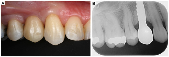 📢 Read our recent publication:

📚 Title: #TopicalOxygenTherapy (blue®m) for Post-Surgical Care Protocols to Promote #WoundHealing in #Periodontology and #DentalImplants: A Case-Based Literature Review

🔗mdpi.com/2673-6373/5/3/…

👨‍🔬 by Cristian Scognamiglio et al.

<a href="/Oral_MDPI/">Oral MDPI</a>