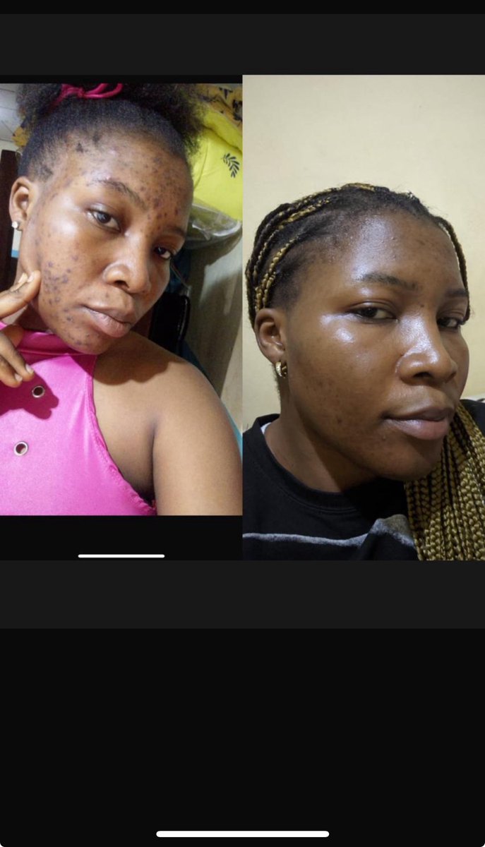 Are you suffering from dark spots, fungi acne, hyperpigmentation, sunburn , ANY SKIN ISSUE please send a dm