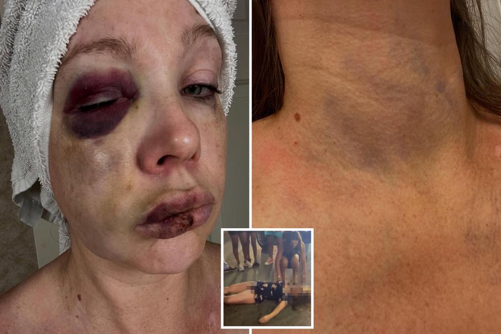 Gruesome photos show severely battered face of the woman knocked out during horrifying Cincinnati brawl trib.al/7Plnh9K