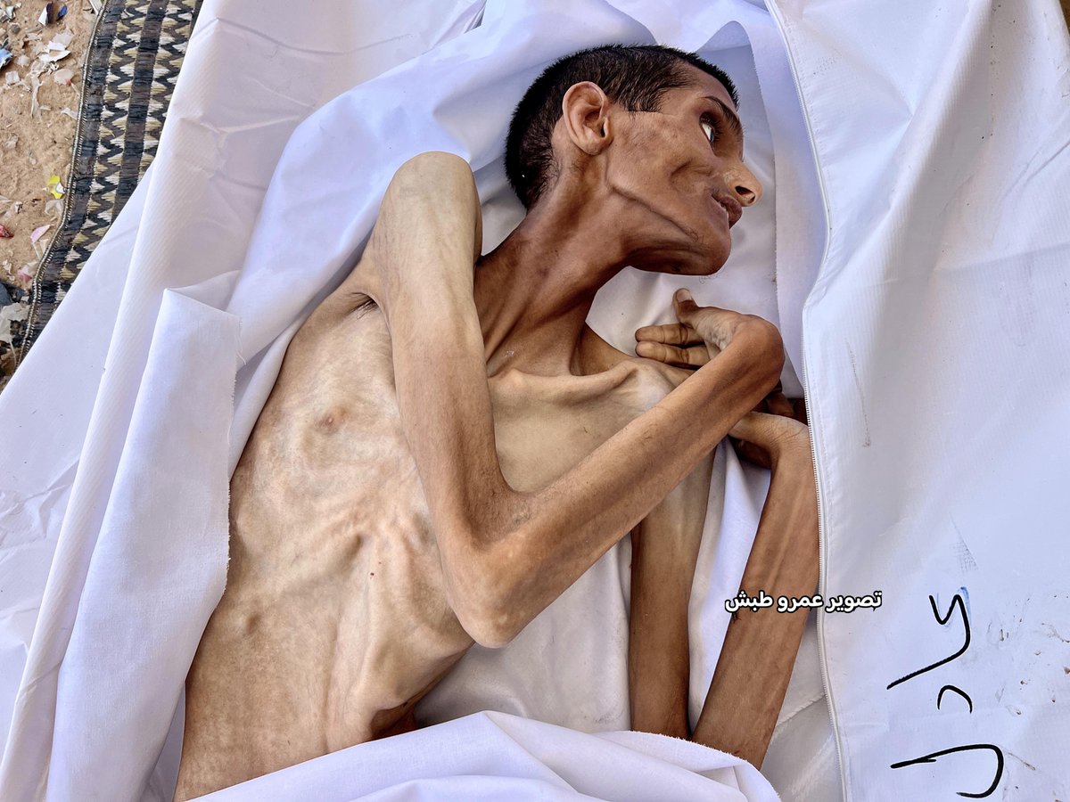 مصادر محلية: وفاة الشاب عادل ماضي "27 عاماً" من سكان مدينة رفح نتيجة سوء التغذية والمجاعة المتفشية في قطاع غزة

#غزه_تموت_جوعاً