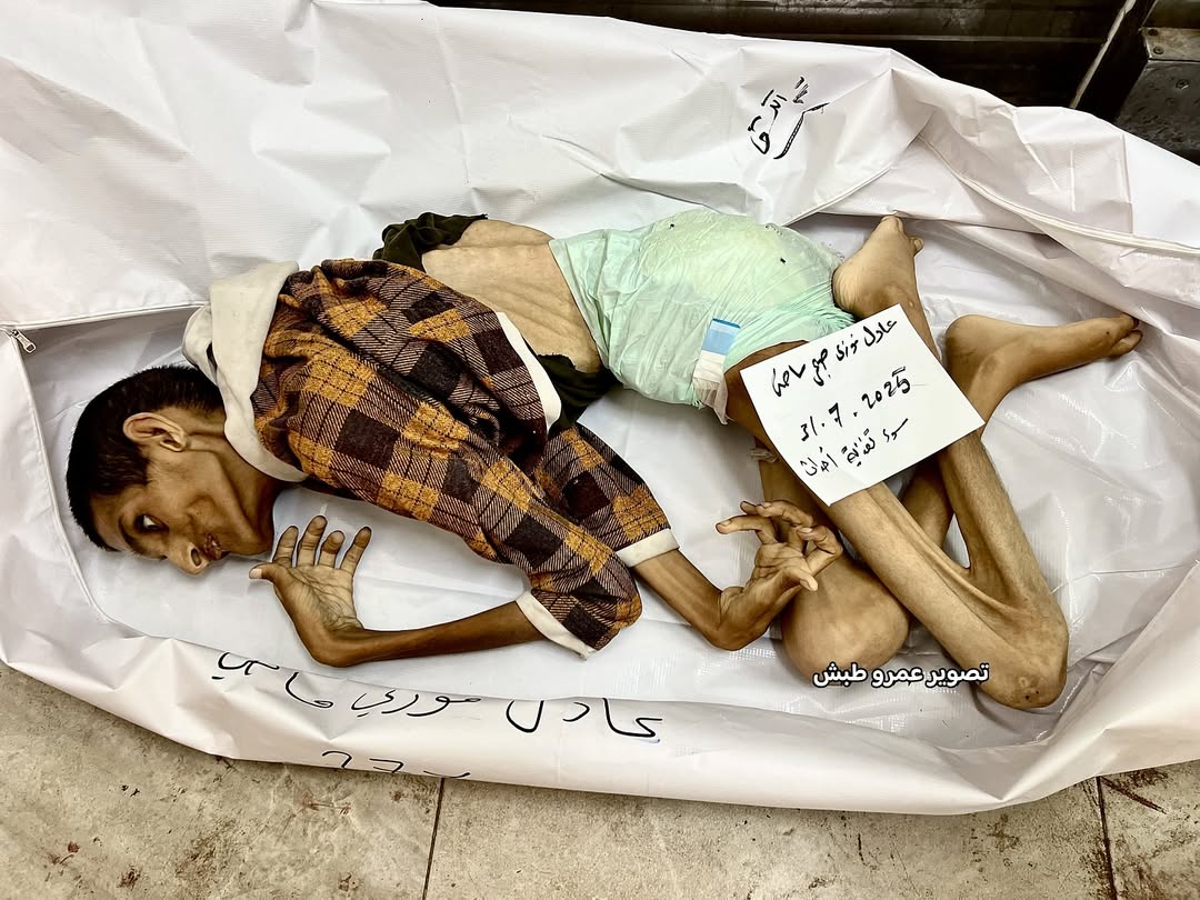 The young man Adel Madi, 27, has died due to starvation, severe malnutrition, and the lack of essential medicines and basic medical treatments.