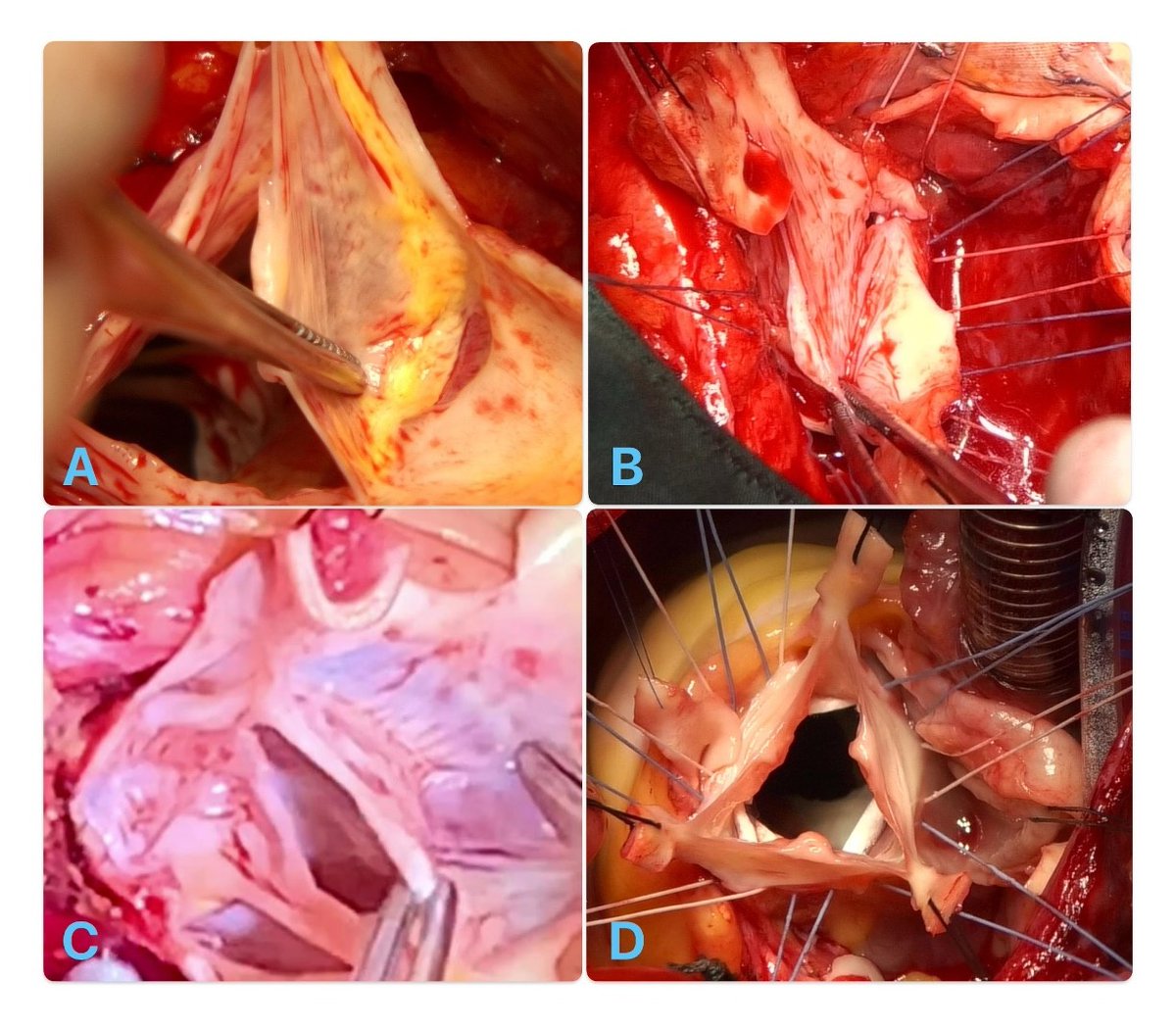 🆕Aortic valve reimplantation — can Modine’s modification be improved?
This commentary introduces a simplified technique with better commissural support using pledgeted sutures. Early results look promising!
🔗oaepublish.com/articles/2574-…
#AorticValveSparing #ModineModification