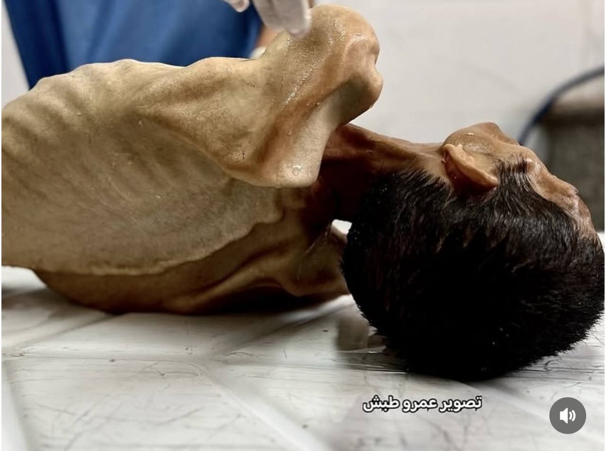 Adil Madi, 27 yaşında... İsrail'in Gazze Şeridi'ne insani yardım girişini engellemesi nedeniyle açlık ve ilaç yokluğundan Han Yunus’taki Nasser Tıp Kompleksi’nde hayatını kaybetti. (Al-Quds)