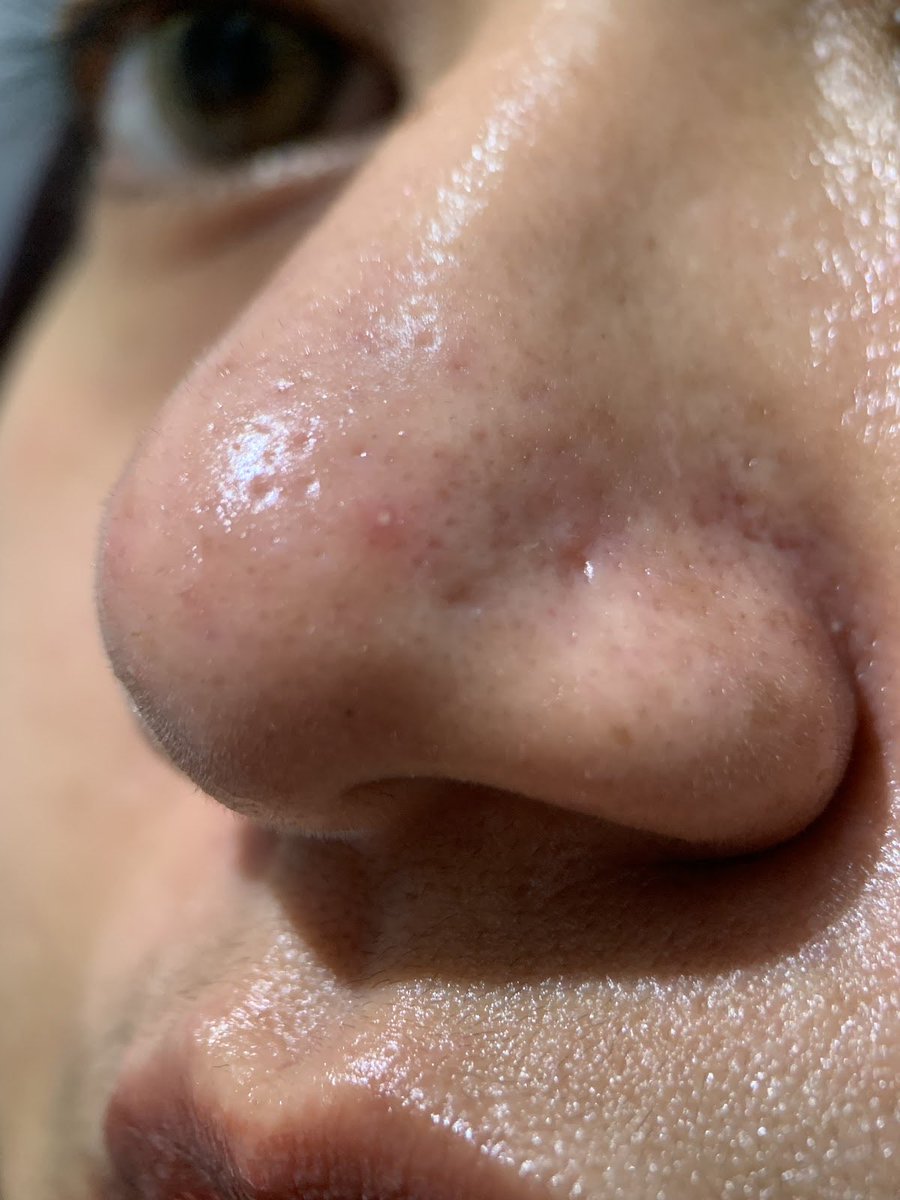 ceramiaa's tweet photo. Kulit berminyak tuh tricky cari sunscreen ‼️

Salah dikit langsung jadi kilang minyak 😭
Akhirnya nemuin yg cucok banget buat oily skin.
NO DRAMA &amp; NO WHITECAST ✨😍 https://t.co/Fc3Nt4RvgI