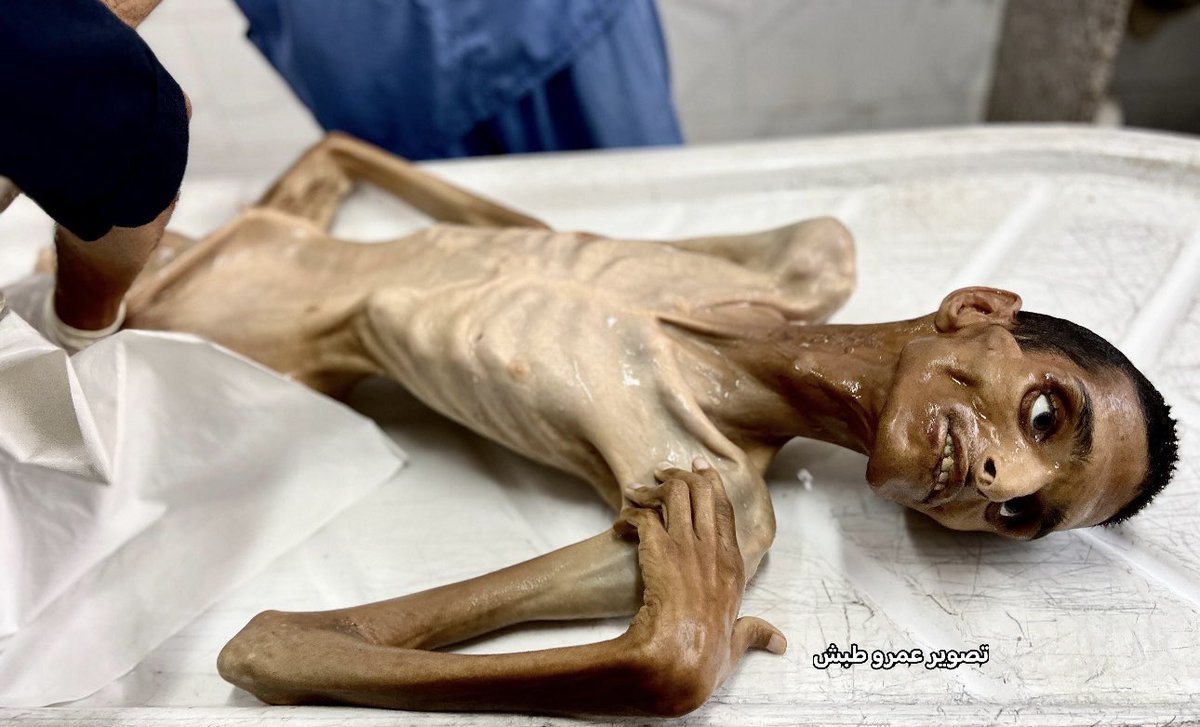 مصادر محلية: وفاة الشاب عادل ماضي "27 عاماً" من سكان مدينة رفح نتيجة سوء التغذية والمجاعة المتفشية في قطاع غزة

#غزة_تموت_جوعا_وقصفا