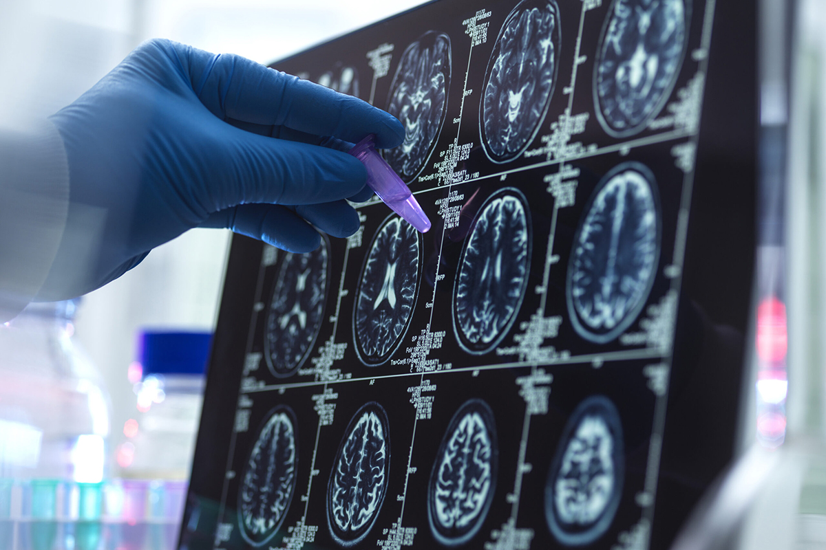 🧬 Obtienen la escala de riesgo genético de alzhéimer más completa f.mtr.cool/txphwqvkbl

🌍 Un equipo internacional con participación de tres centros del CSIC ha combinado estudios genéticos de cerca de 100.000 personas sanas y enfermas en Europa, Asia, África y América.