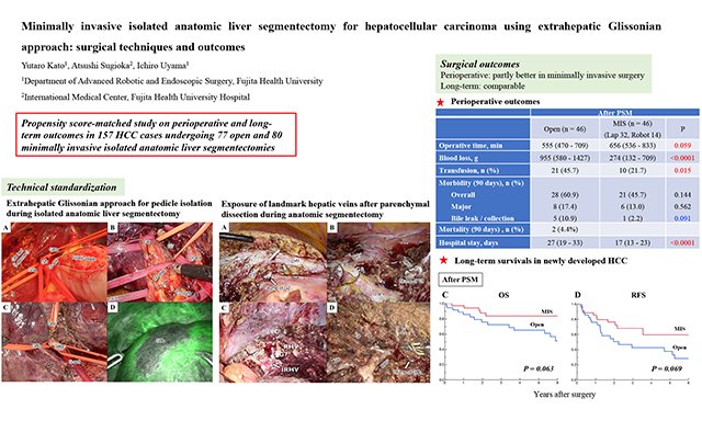 🔍 #MISHighlight
Kato, Sugioka &amp; Uyama standardized IA-Seg liver resection using an extrahepatic Glissonian approach!
✅ Safe, reproducible &amp; oncologically sound
🩸 Minimal bleeding
⏱️ Quick recovery
🤖 Works for both laparoscopic &amp; robotic
🔗oaepublish.com/articles/2574-…