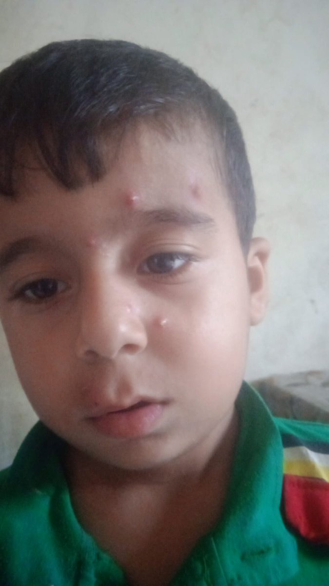 Anhedonya (@psanhedonya) on Twitter photo 🚨 $3⃣ in Last Month
🆘 <a href="/ARagheb48557/">Fatima Ragheb 🍉 🇵🇸</a> must take 4yo Mohd to a Dr for a painful, pimply rash. He needs tonsil/adenoid removal as he's often ill & has problems breathing. His bro needs a root canal. Plz help w
▫️Dr trip ▫️Surgery ▫️Preschool
📢 $ 426
✅ chuffed.org/project/132696 ✅ 🚨 $3⃣ in Last Month
🆘 <a href="/ARagheb48557/">Fatima Ragheb 🍉 🇵🇸</a> must take 4yo Mohd to a Dr for a painful, pimply rash. He needs tonsil/adenoid removal as he's often ill & has problems breathing. His bro needs a root canal. Plz help w
▫️Dr trip ▫️Surgery ▫️Preschool
📢 $ 426
✅ chuffed.org/project/132696 ✅