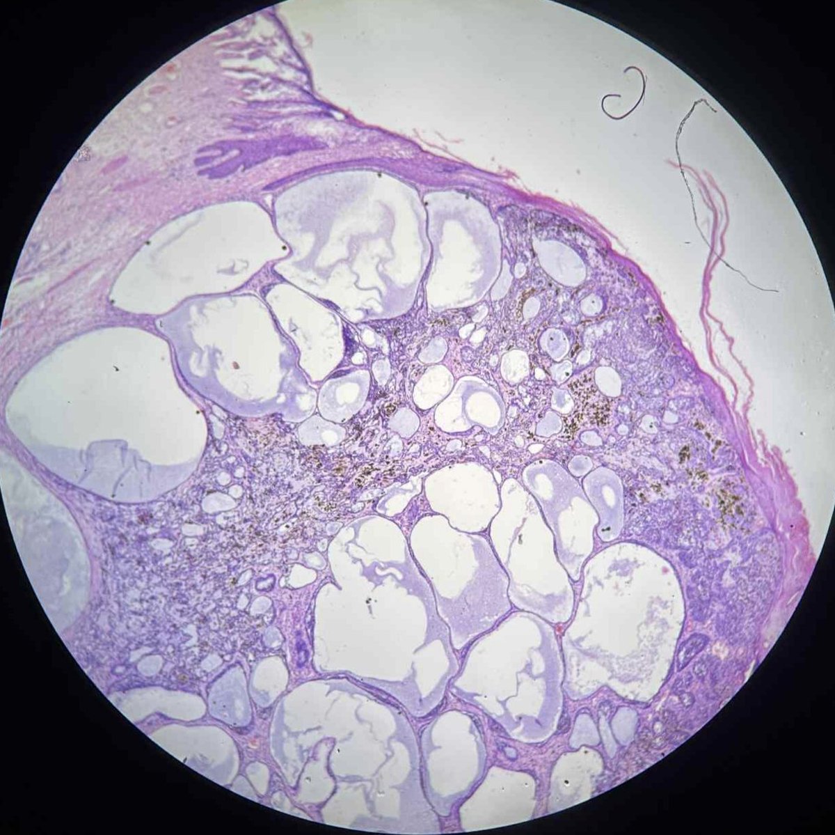 pathphyo's tweet image. 41 yrs old male with mole on head. A nice example of cystic pigmented basal cell carcinoma. #pathology #dermpath #BCC