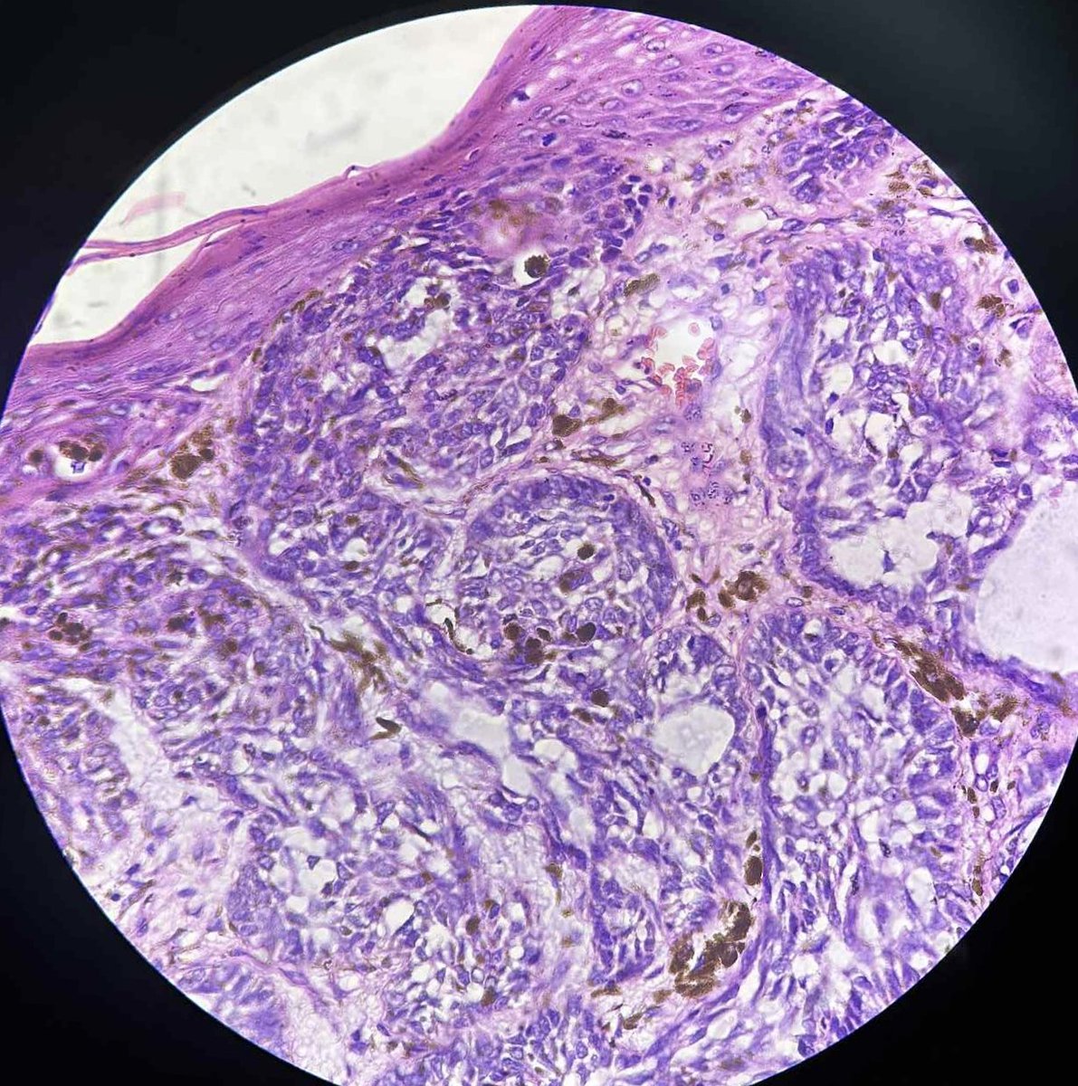 pathphyo's tweet image. 41 yrs old male with mole on head. A nice example of cystic pigmented basal cell carcinoma. #pathology #dermpath #BCC