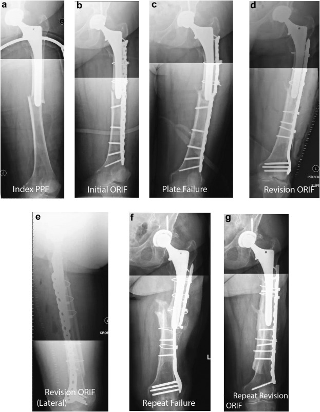 Arthroplasty Today (@arthrotoday) on Twitter photo 1 institution, 1 non-contact bridge plate, 6 cases of implant failure.
Share your tips for ensuring success when plating periprosthetic femur fractures: <a href="/yoon_rs/">Richard S. Yoon, MD</a> @ZachWorkingMD <a href="/JanetConwayy/">Janet Conway MD, FAAOS</a> <a href="/orthotraumamd/">Jan Szatkowski</a>
arthroplastytoday.org/article/S2352-… 1 institution, 1 non-contact bridge plate, 6 cases of implant failure.
Share your tips for ensuring success when plating periprosthetic femur fractures: <a href="/yoon_rs/">Richard S. Yoon, MD</a> @ZachWorkingMD <a href="/JanetConwayy/">Janet Conway MD, FAAOS</a> <a href="/orthotraumamd/">Jan Szatkowski</a>
arthroplastytoday.org/article/S2352-…