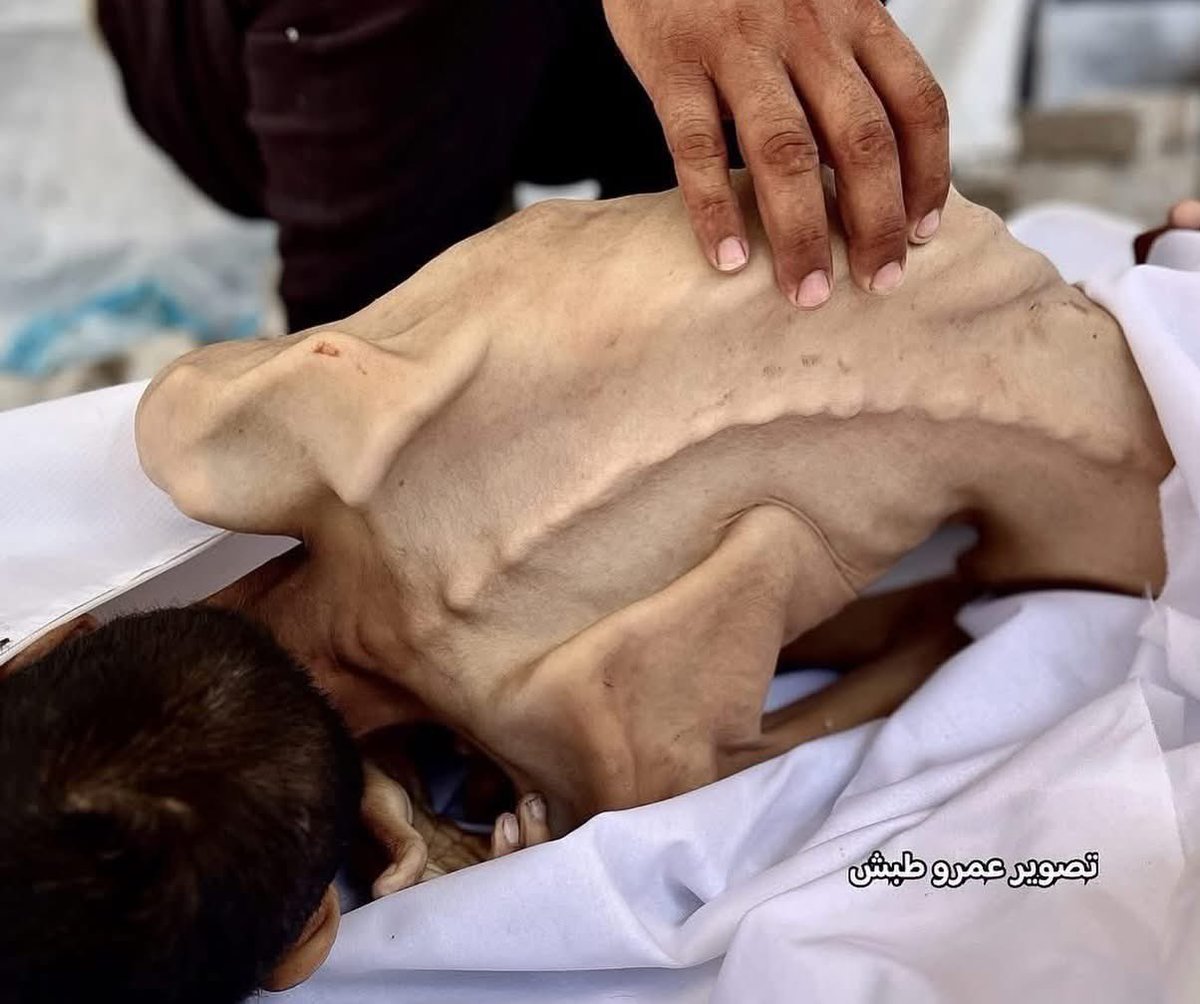 27 yaşında bir Filistinli genç daha, açlığa yenik düştü. Açlık, iliklerine kadar işlemişti; yaşamda kalabilmek için bir lokma dahi bulamamıştı. Sessiz bir çığlık gibi gözlerimizin önünde can verdi. Takvimler 2025’i gösteriyor ve biz hâlâ bu karelere tanıklık edebiliyorsak, bu