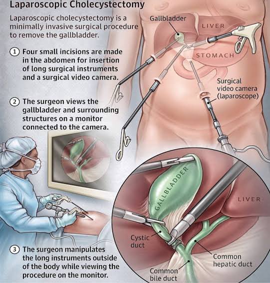 KnowMedBetter's tweet photo. 2️⃣ Cholecystectomy
📌Indication: Symptomatic gallstones, cholecystitis
🧠Pearl: Always identify Calot’s triangle carefully!
🚨Watch for bile duct injury.

  #NEETPG2025 #Medstudent #Pyqs #ImageBased #MedTwitter
#Medstudent #Pyqs
#Incet #Exam #surgery https://t.co/HgfTvtrBjD