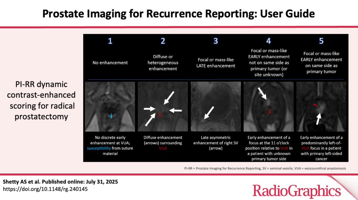 Anup Shetty (@nupedogg) on Twitter photo After treatment for prostate cancer, use the PI-RR system in reporting suspicious MRI findings, with different standards after prostatectomy or radiation therapy. Our work in <a href="/RadioGraphics/">RadioGraphics</a> provides a detailed guide:
pubs.rsna.org/doi/10.1148/rg…
#prostatecancer #MRI #radiology After treatment for prostate cancer, use the PI-RR system in reporting suspicious MRI findings, with different standards after prostatectomy or radiation therapy. Our work in <a href="/RadioGraphics/">RadioGraphics</a> provides a detailed guide:
pubs.rsna.org/doi/10.1148/rg…
#prostatecancer #MRI #radiology