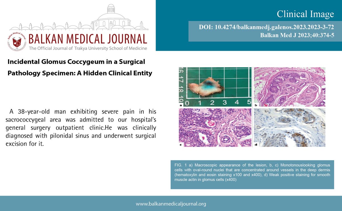 Incidental Glomus Coccygeum in a Surgical Pathology Specimen: A Hidden Clinical Entity
You can see the free full text of the research by Recep Bedir et al.
Link : balkanmedicaljournal.org/uploads/pdf/pd…