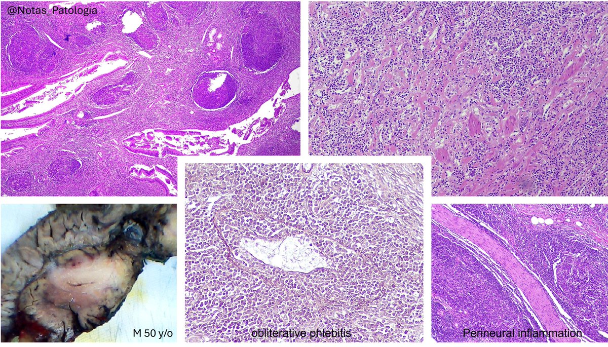IgG4-Related Disease and Autoimmune Pancreatitis: Updated Review

1. Introduction

IgG4-related disease (IgG4-RD) is a systemic immune-mediated fibroinflammatory condition characterized by infiltration of IgG4-positive plasma cells, storiform-type fibrosis, and obliterative