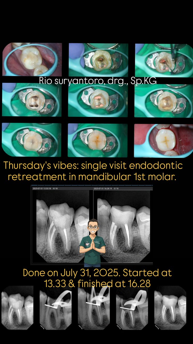 Thursday's vibes: single visit endodontic retreatment in mandibular 1st molar. 
Done on July 31, 2025. Started at 13.33 &amp; finished at 16.28.

#endodontist #doktergigi #spesialiskonservasigigi