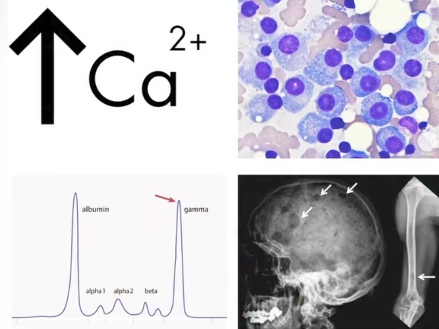 What is the most likely diagnosis❓

A. Chronic lymphocytic leukemia
B. Non-Hodgkin lymphoma
C. Multiple myeloma
D. Waldenström macroglobulinemia