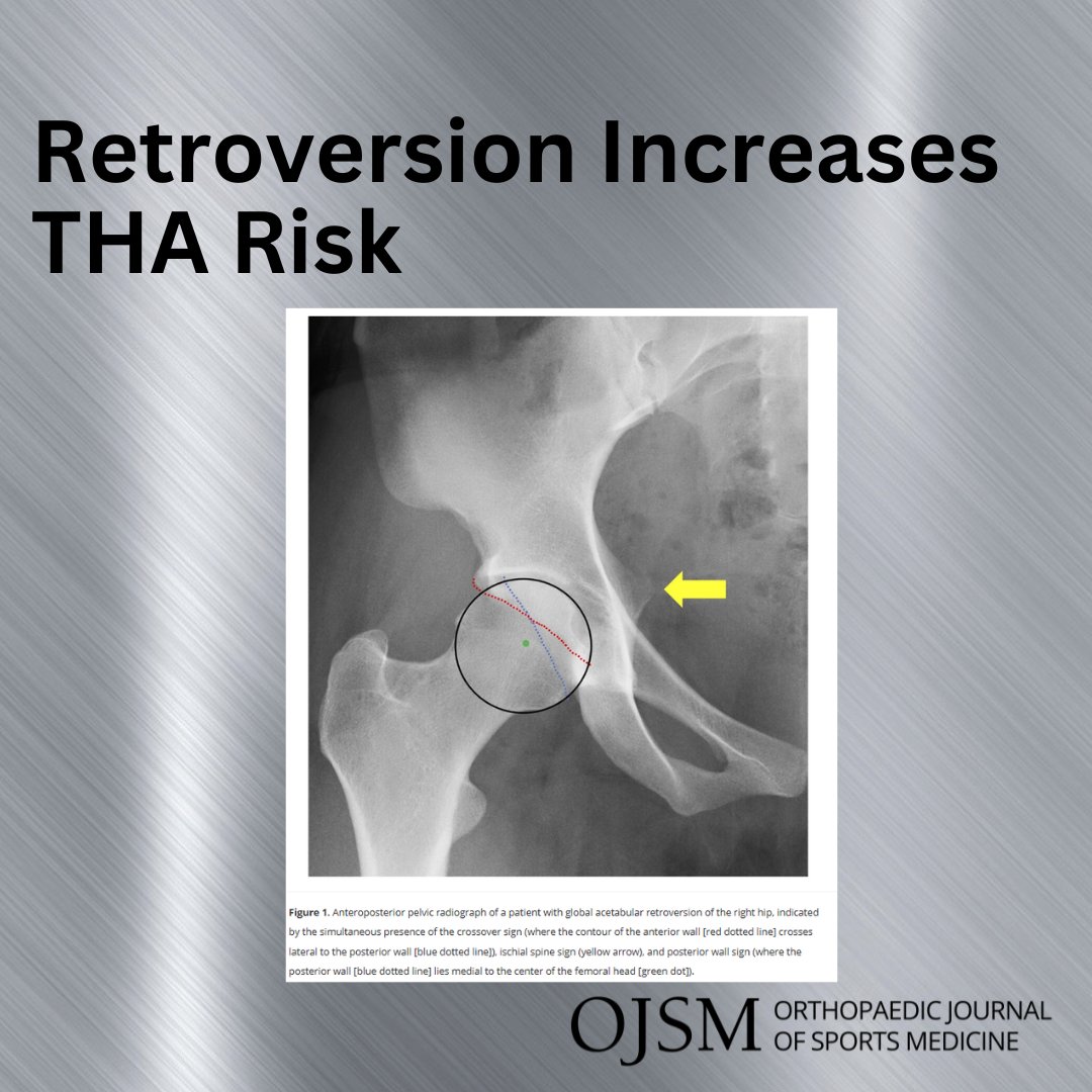 AOSSM Journals (@aossmjournals) on Twitter photo Global acetabular retroversion is associated significantly lower THA-free survivorship at long-term follow-up after hip arthroscopy relative to matched controls.
journals.sagepub.com/doi/10.1177/23…
<a href="/StephenGillinov/">Stephen Gillinov, MD</a> <a href="/SDMartinMD/">Dr. Scott Martin</a> Global acetabular retroversion is associated significantly lower THA-free survivorship at long-term follow-up after hip arthroscopy relative to matched controls.
journals.sagepub.com/doi/10.1177/23…
<a href="/StephenGillinov/">Stephen Gillinov, MD</a> <a href="/SDMartinMD/">Dr. Scott Martin</a>