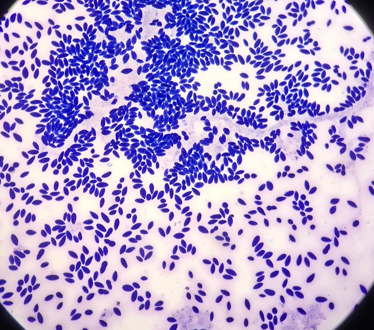 23/F. Pleural fluid cytology