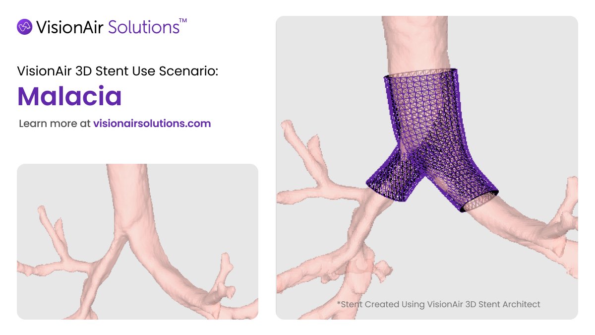 #MalaciaMonday

Diagnosis: Secondary Malacia presenting as stenosis.

Challenge: Airway instability requiring personalized intervention.

Solution: A patient-specific stent shaped using V3D software to conform to the patient’s anatomical curve.

This is how 3D planning supports