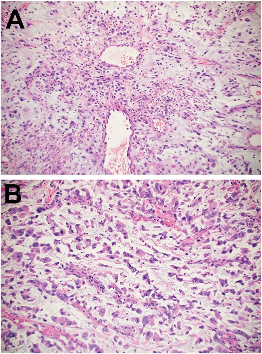 New in #HumPathol: Invasive urothelial carcinoma with chordoid and myxoid features shows increased RAS/RAF pathway alterations. sciencedirect.com/science/articl… #pathology #PathTwitter #PathX #GUpath
