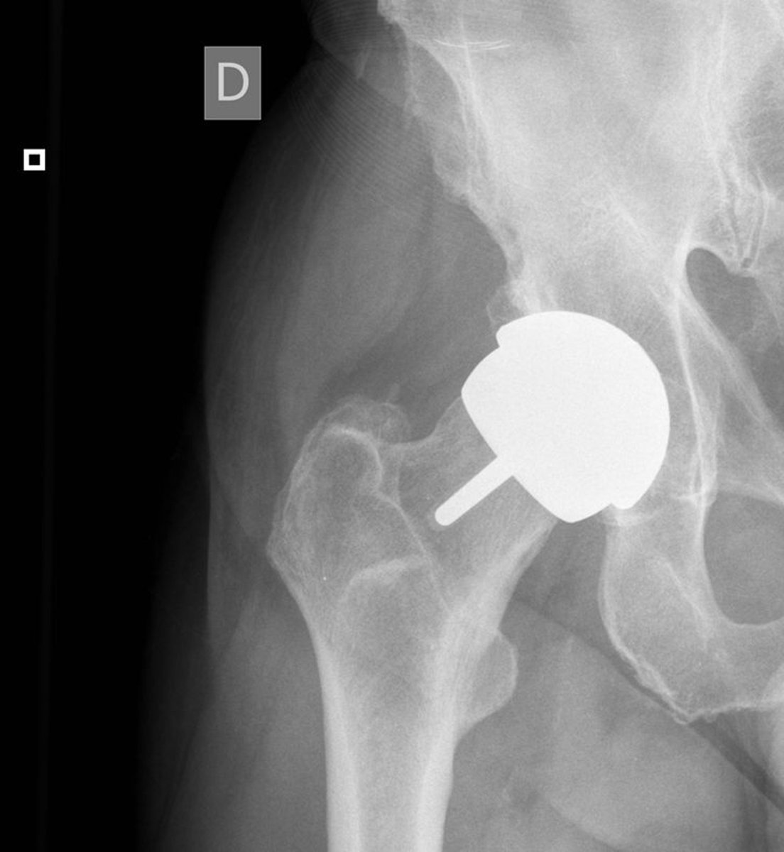 For #ThoracicThursday -- a tricky one.  74 yo with chronic dyspnea and chest tightness, attributed to known CHF and hypothyroidism.  Remote history of hip replacements -- no current hip problems, though mild peripheral neuropathy.  Chest x-ray and spirometry normal.  Thoughts?