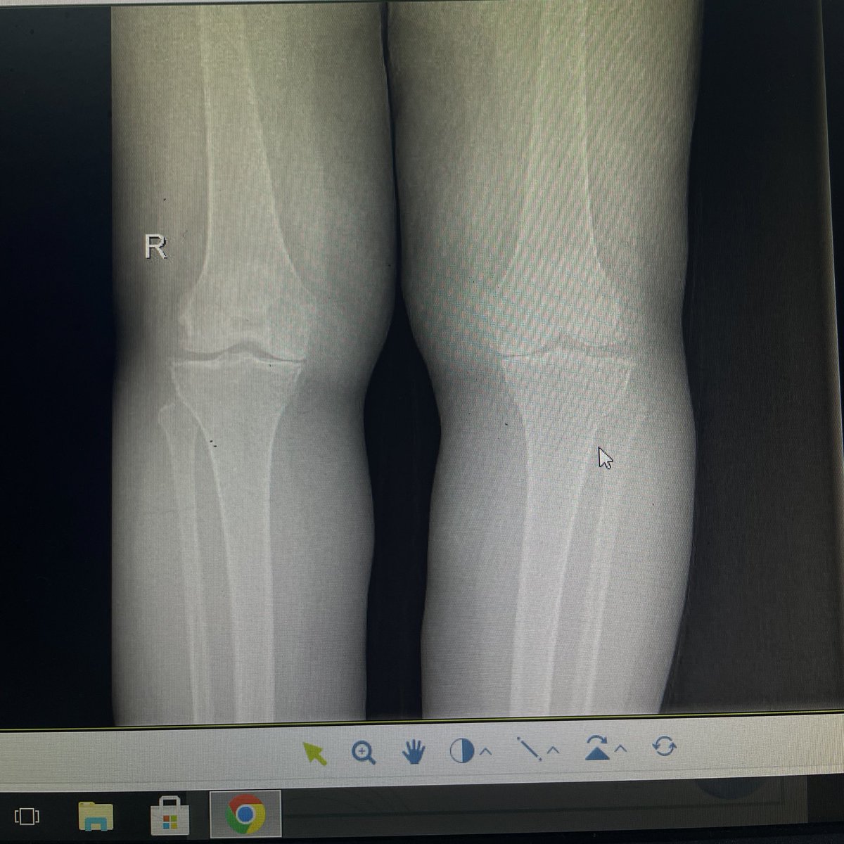1 month in Musculoskeletal✅
صرت أسوي mulligan و taping ✋🏼