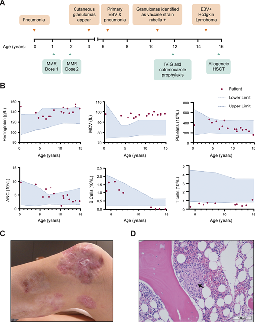 LabWaggoner's tweet image. ASXL1 deficiency causes epigenetic dysfunction, combined immunodeficiency, and EBV-associated lymphoma @JExpMed @TurveyLab
rupress.org/jem/article/22…