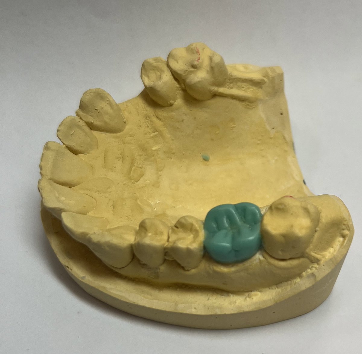 Wax up (upper first molar)🦷